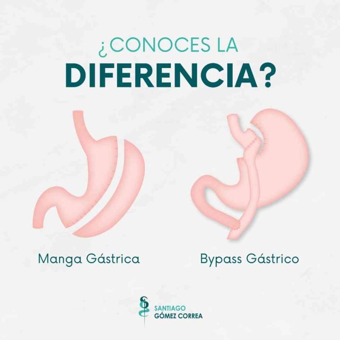 Conoces La Diferencia Entre Manga G Strica Y Bypass G Strico Dr