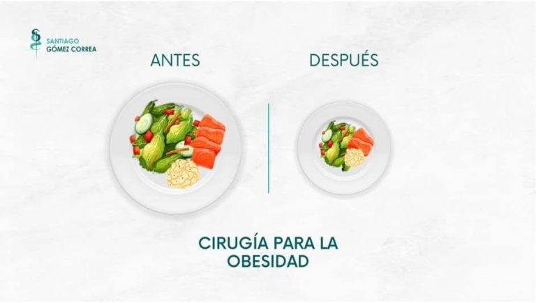 Los cambios en la alimentación después de una Cirugía para la Obesidad-min