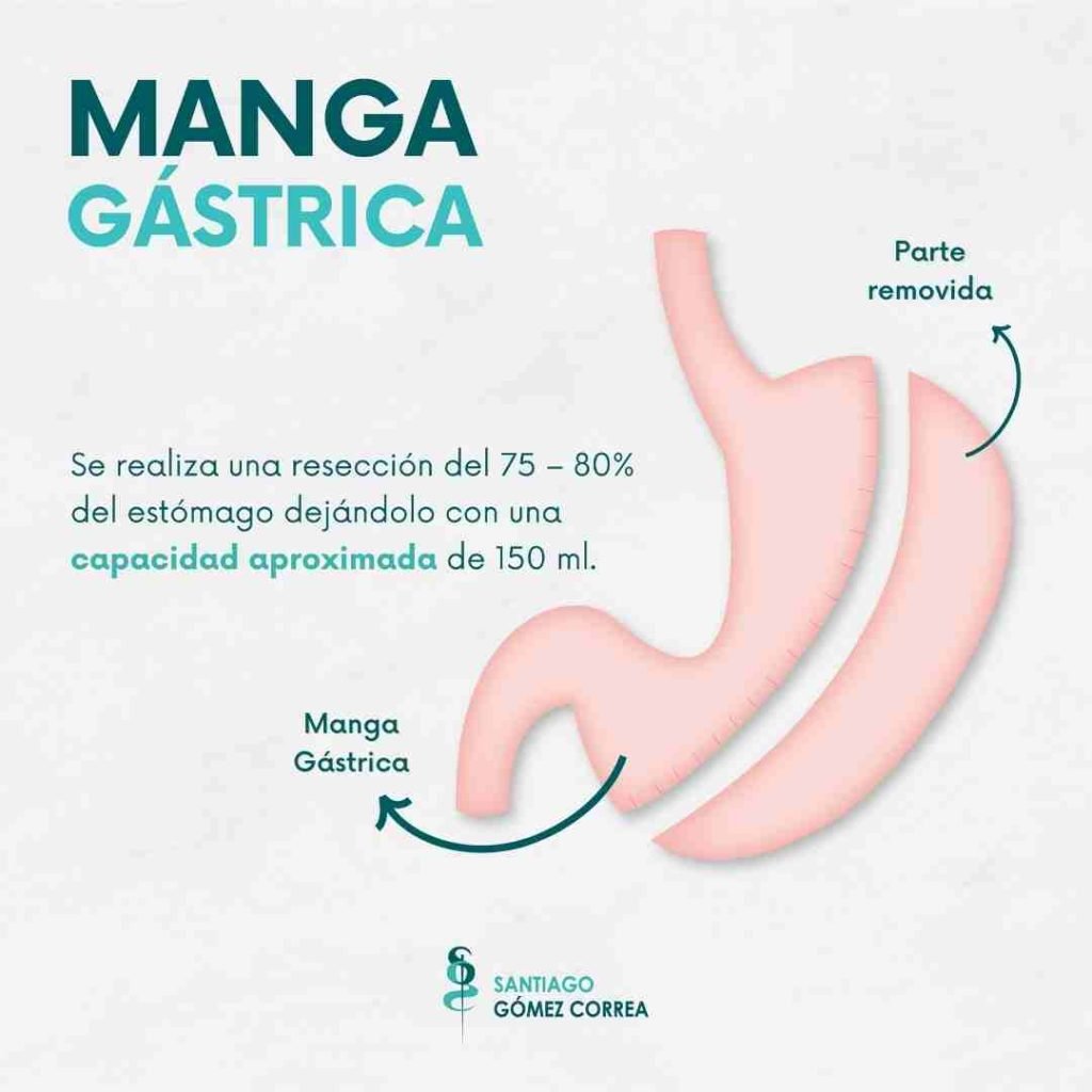 ¿conoces La Diferencia Entre Manga Gástrica Y Bypass Gástrico Dr Santiago Gomez Correa I 