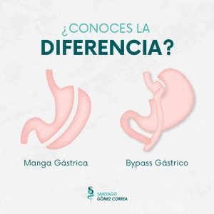 conoce las diferencias entre manga gástrica y Bypass gástrico