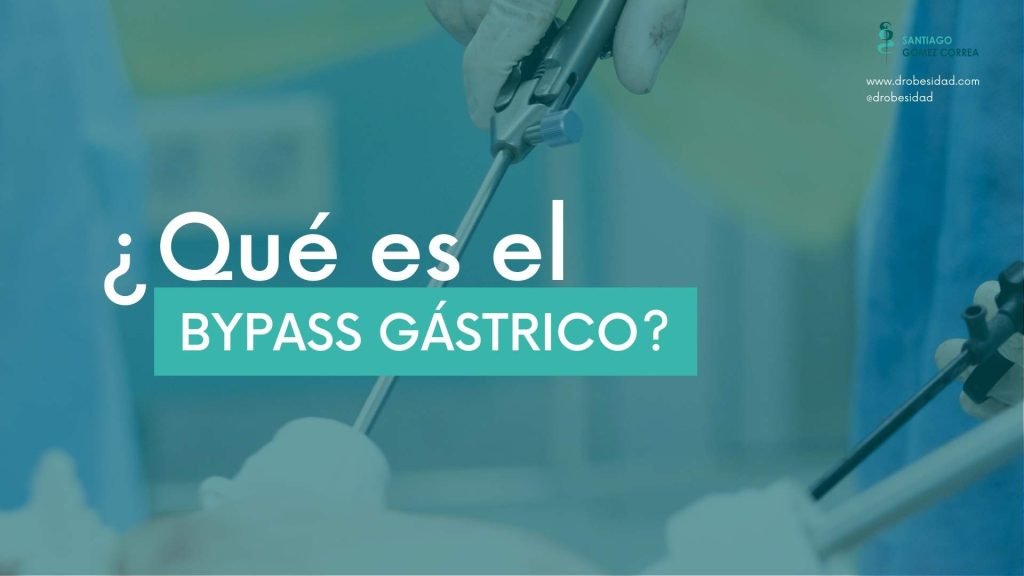 que es bypass gastrico