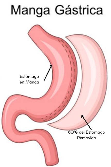 Dr Santiago Gómez Manga Gástrica en Medellín