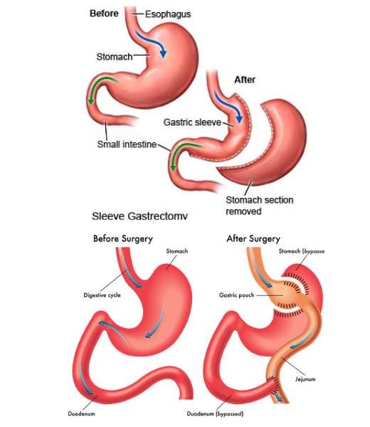 Bariatric Surgery in Colombia Dr Santiago Gómez Correa