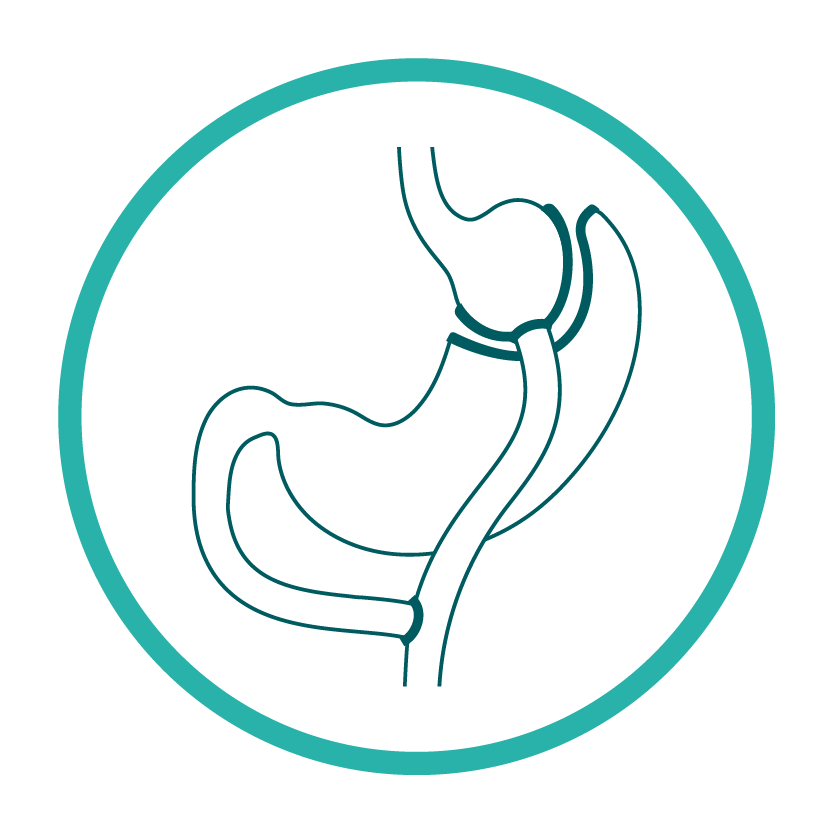 Diferencia entre el Bypass y la Manga Gástrica - bypass Gastrico - Dr Santiago Gómez Correa Cijano Bariátrico en Medellín