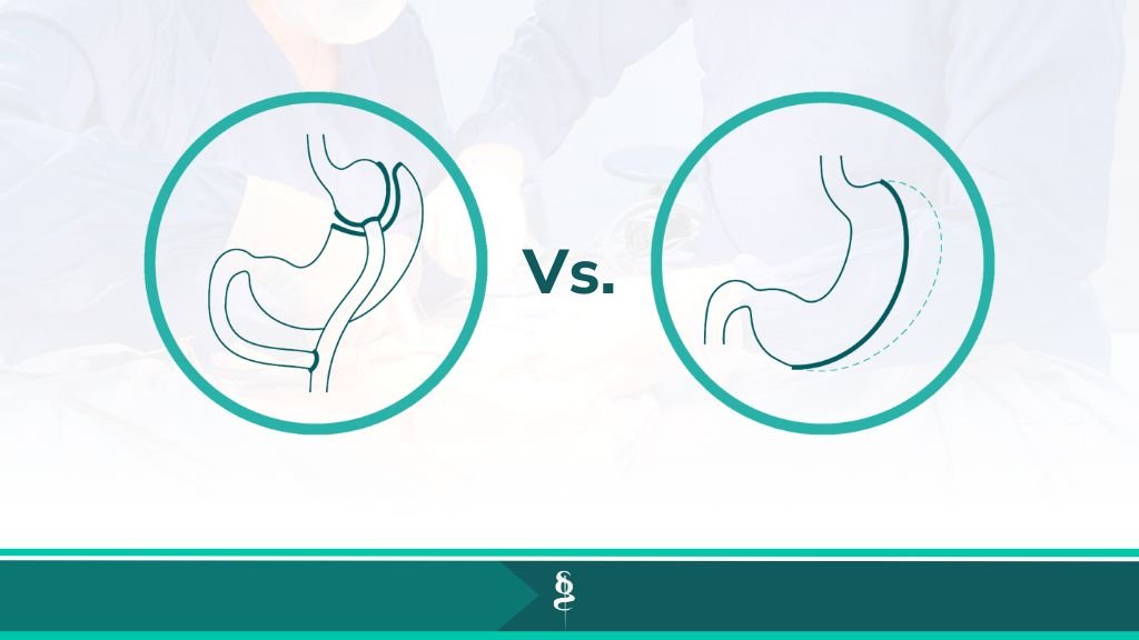 Diferencia entre el Bypass y la Manga Gástrica - Cirujano Bariátrico en Medellín - Santiago Gómez Correa