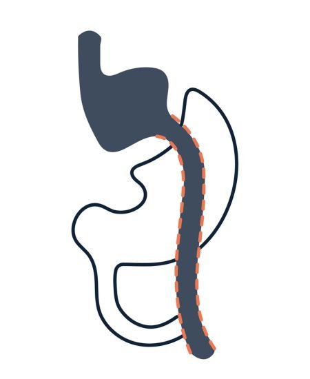 Gastric Bypass Surgery Dr Santiago Gómez Correa Cirujano Bariátrico