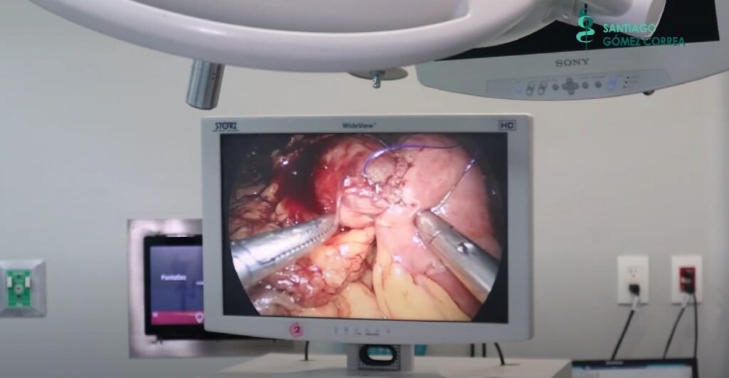 Creación de la anastomosis