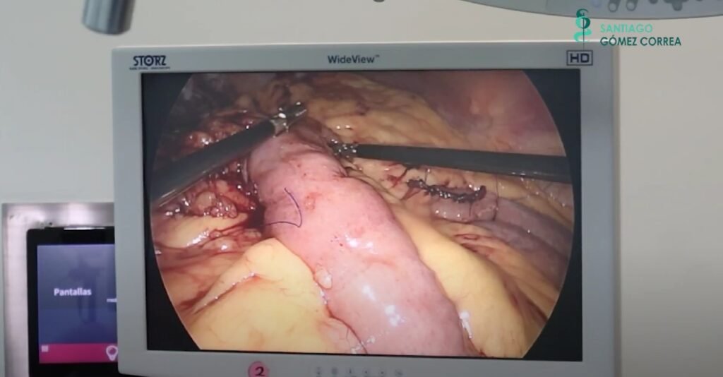 Creación de la anastomosis 2