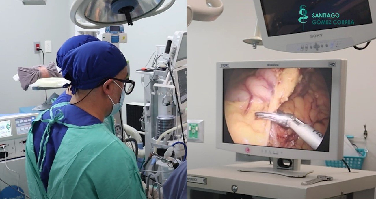 cirug-a-de-revisi-n-bari-trica-paso-a-paso-con-video-dr-santiago