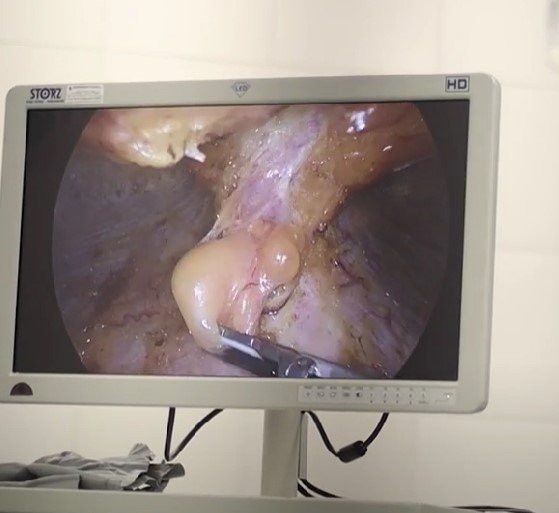 Barriga diástasis abdominal fotos