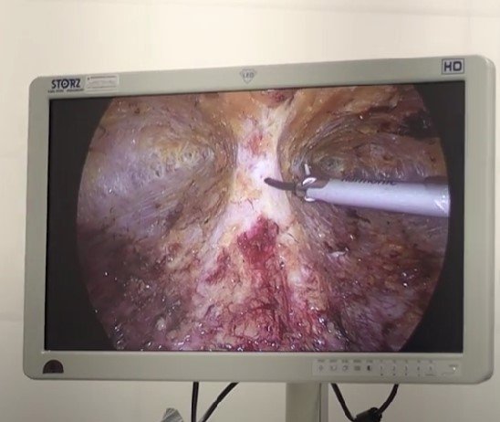 Operacion diastasis abdominal fotos